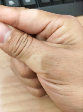 腋下长了一片红癣图片(吓我一大跳) - 赤虎壹号