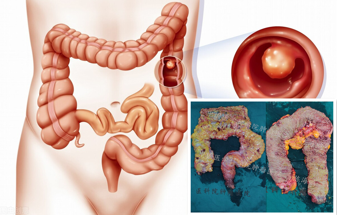 肠道内密密麻麻的息肉咋回事？一个个切吗？
