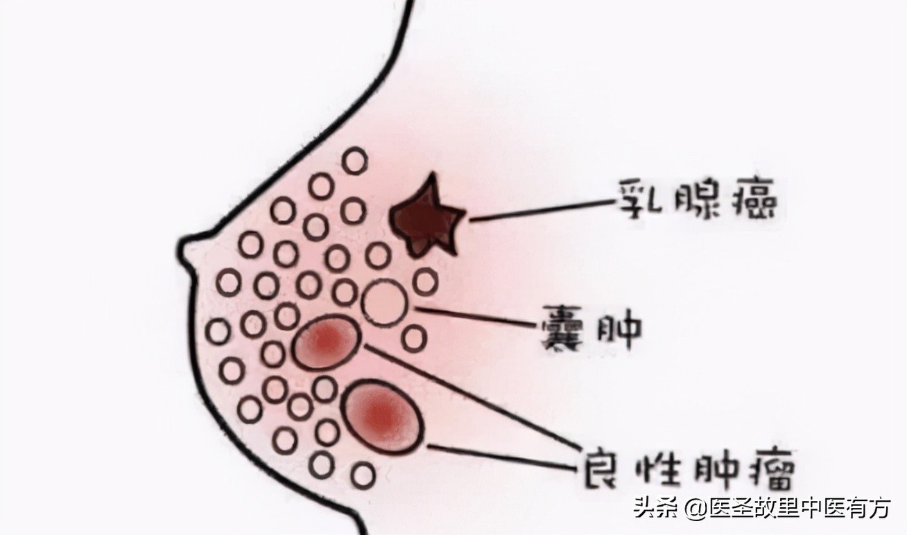 老中医总结：史上最全治疗乳腺增生、乳腺结节的中成药，建议收藏