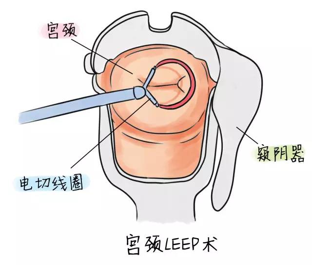 宫颈锥切哪个好?一文教你怎么选