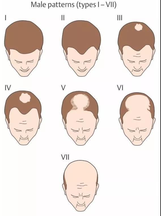 脱发常见的3种类型及应对办法，快来对号入座拯救头发