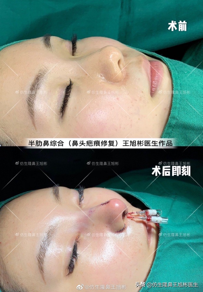 初鼻整形：鼻综合（鼻基底填充+鼻翼缩小上提+鼻骨内推）气质换人