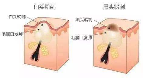 你脸上长的小疙瘩是闭口还是黑头？什么是闭口，哪些产品能祛除？
