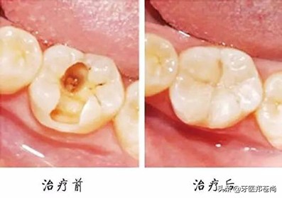 根管治疗是在牙齿上做了什么？根管治疗后牙齿还能用多久？