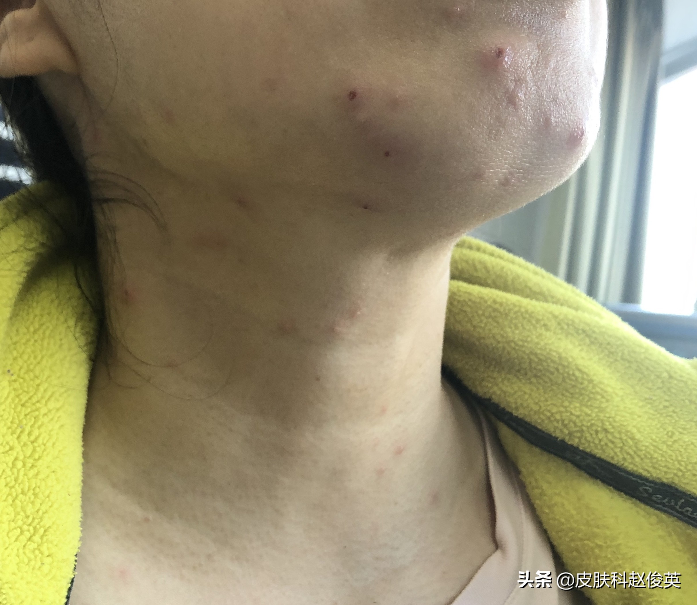 成人水痘,发病更为凶险,四字教你判别