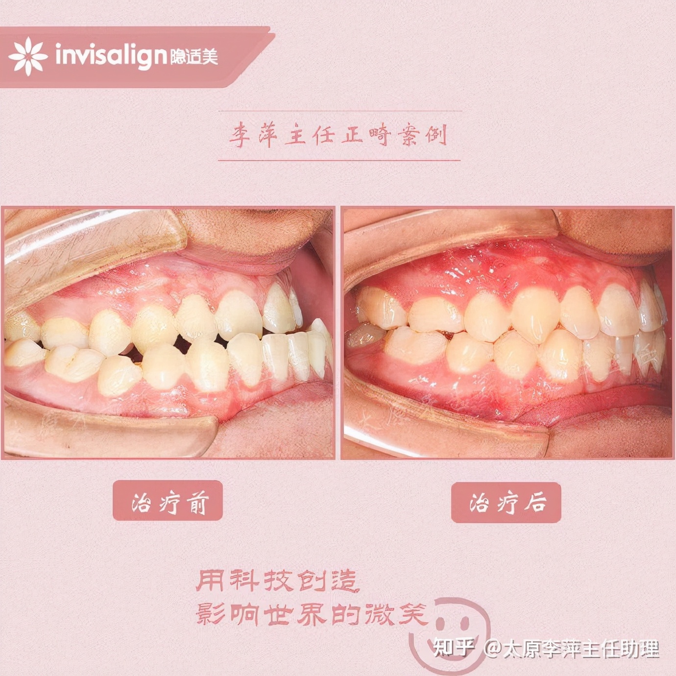太原牙齿矫正：隐形牙套效果好不好？看这些病例你就知道了