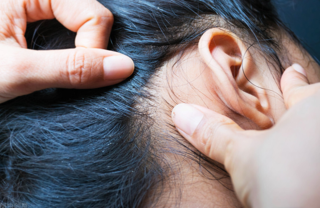 30年前,虮子在男女老少人头上很常见,为啥忽然间消失不见了?