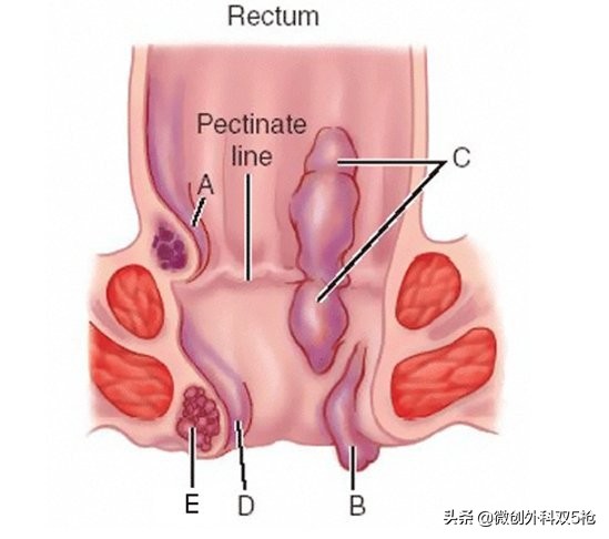十人九痔，你有没有？教你认识和日常防治痔疮