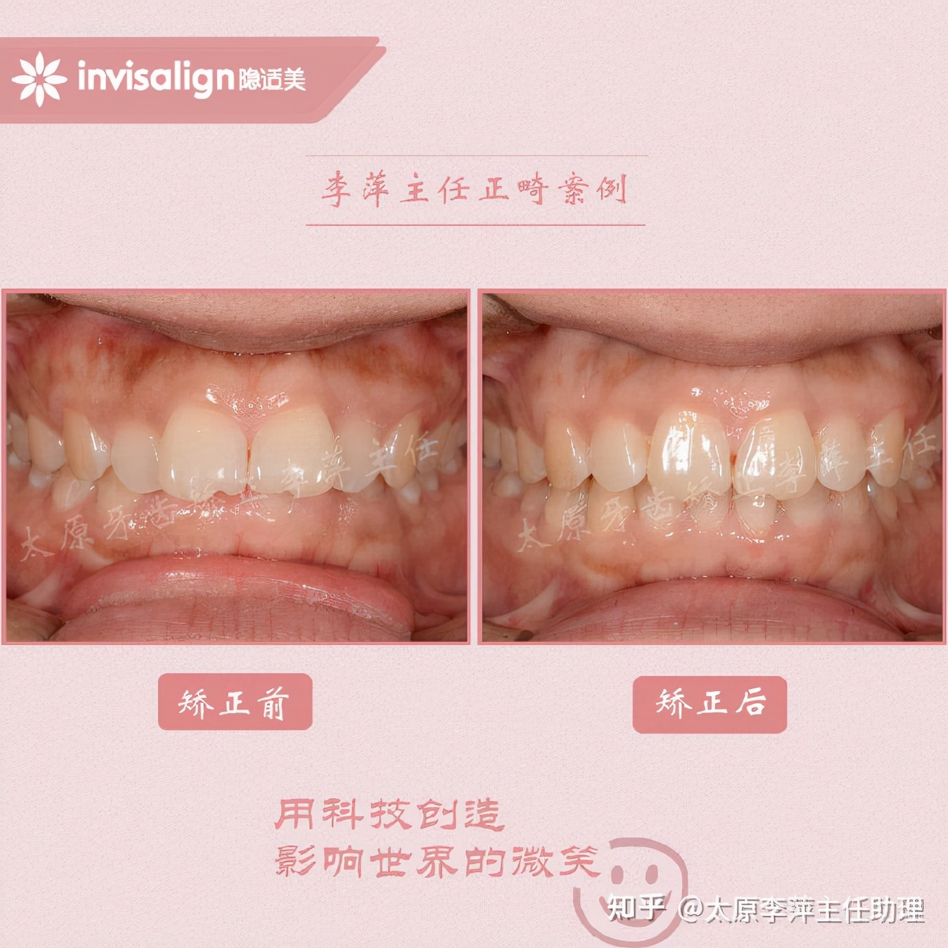 太原牙齿矫正：隐形牙套效果好不好？看这些病例你就知道了