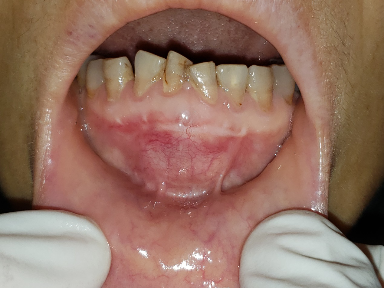4) 第一磨牙萌出部位呈等差数列样显著的生长发育特点-混合牙列期咬合-医学