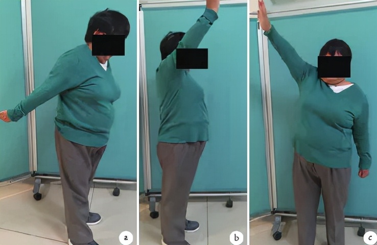 长在肩膀上的“结石”：6旬阿姨肩膀半夜痛醒误以为肩周炎，原来是肩袖钙化性肌腱炎