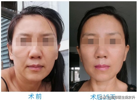 提升苹果肌,去掉法令纹,我用了15天