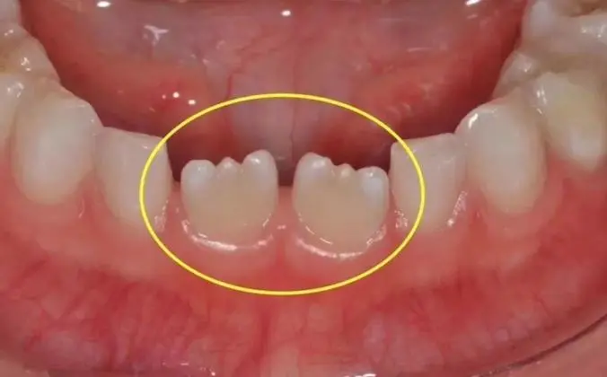 乳牙脱落,恒牙长出