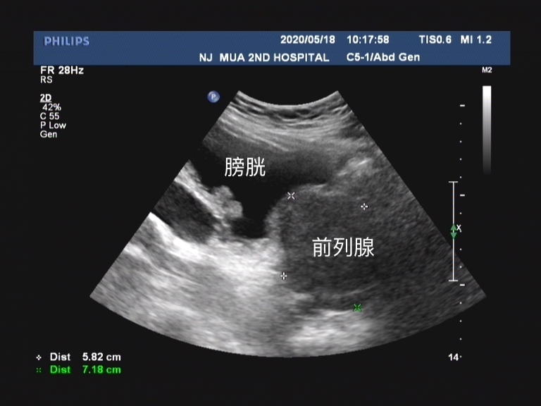 前列腺增生不能根治，那这个手术做了有什么用？为啥还要做手术？