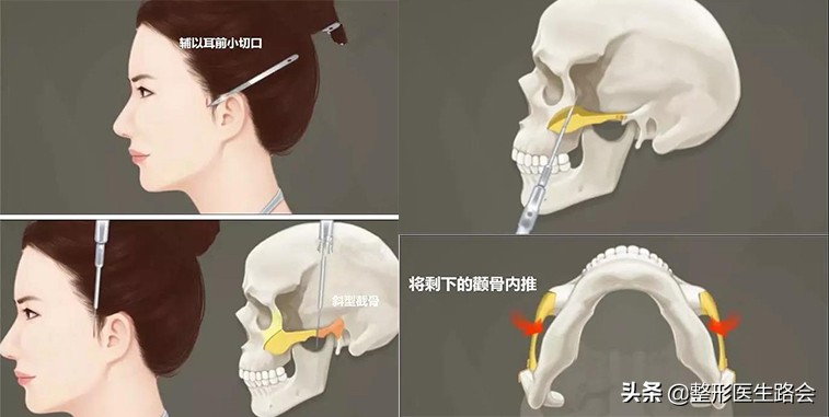 颧骨高很容易变“菱形脸”刻薄还显老