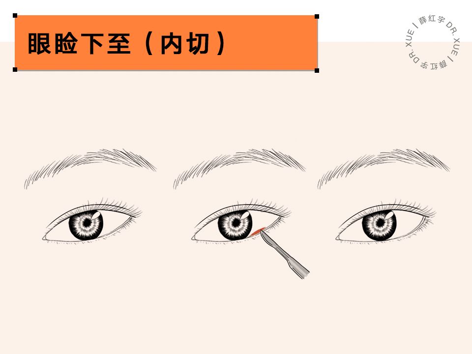 要不要开外眼角？要不要做眼睑下至？