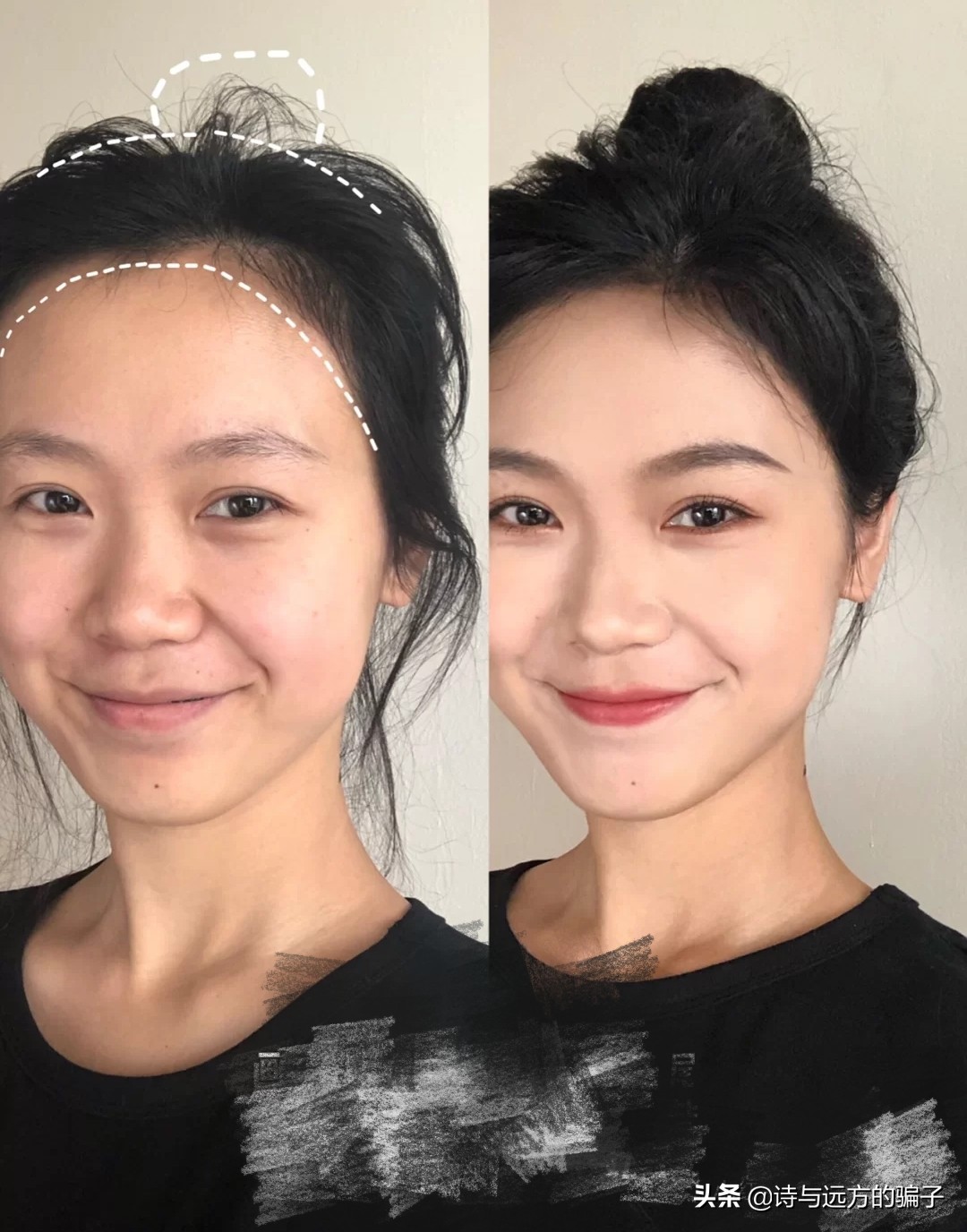 发际线自救，跟高额角，方脑门说拜，秃头女孩实现圆润饱满小脸梦