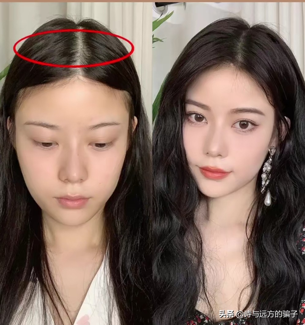 发际线自救，跟高额角，方脑门说拜，秃头女孩实现圆润饱满小脸梦