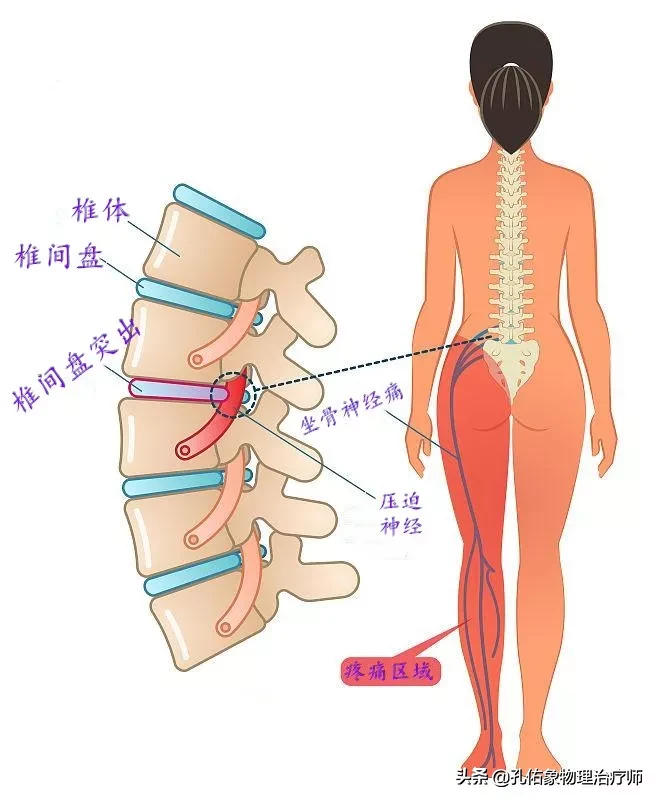 腰椎间盘突出的朋友,为何反复治不好?手术就能解决?告知您内幕