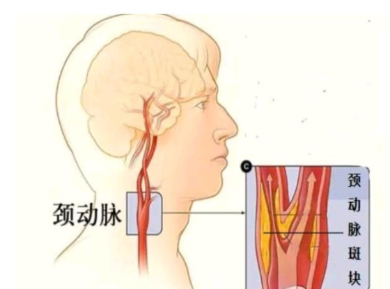 中年男子患颈动脉斑块，吃了5年他汀，看看现在的检查化验结果