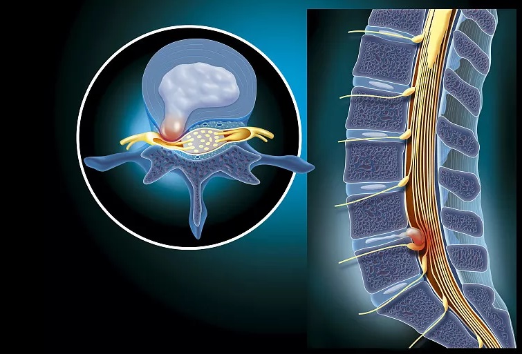 椎间盘突出示意图3D图片