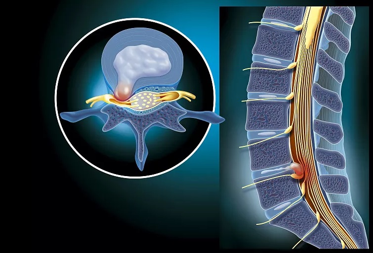 80%腰椎间盘突出不用手术?怎么缓解?医生给出3个标准答案