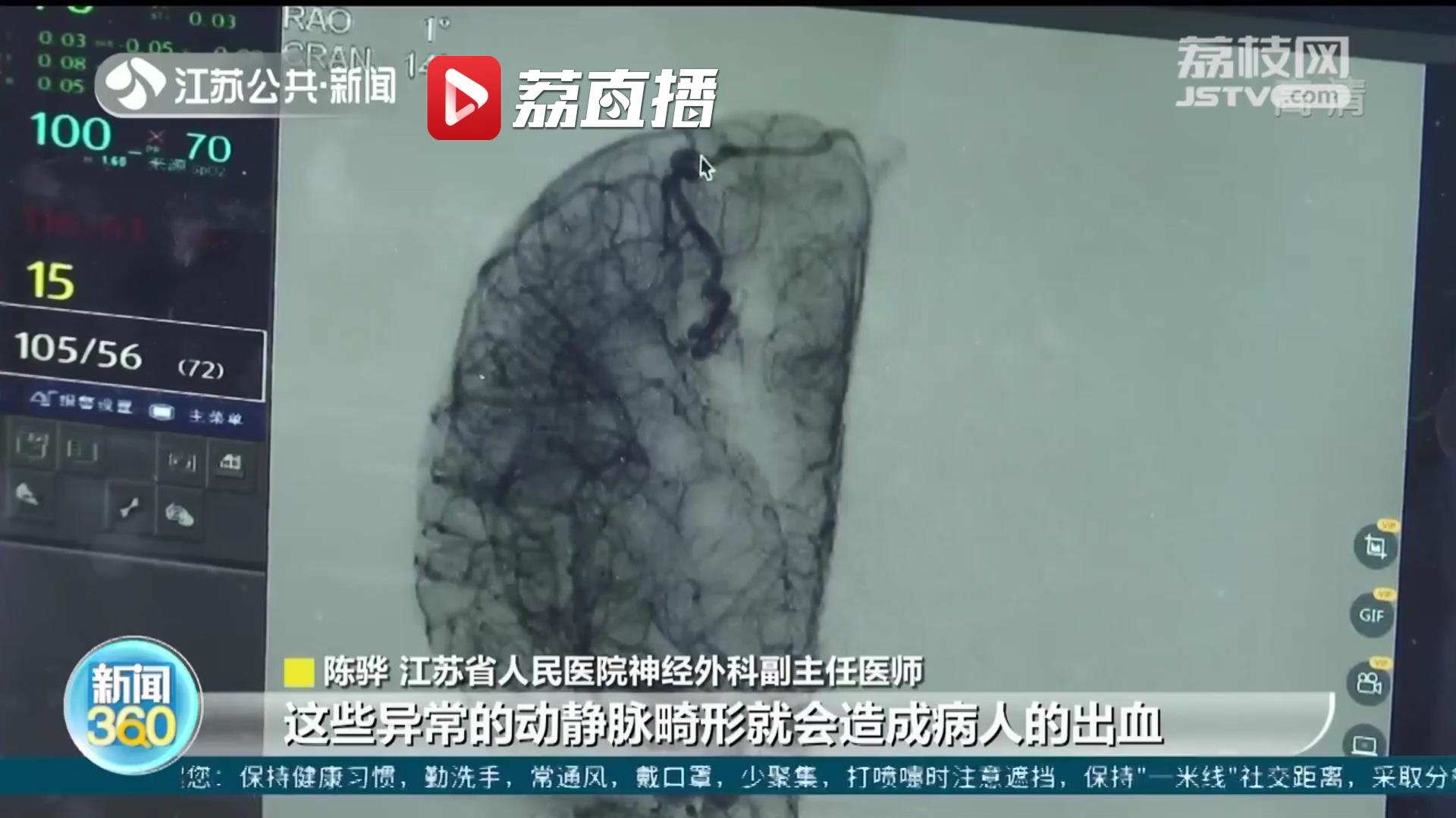 警惕青少年脑卒中 出现症状要及时就医