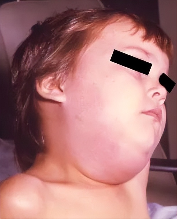 注意！流行性腮腺炎专挑孩子下手，搞不好还影响生育