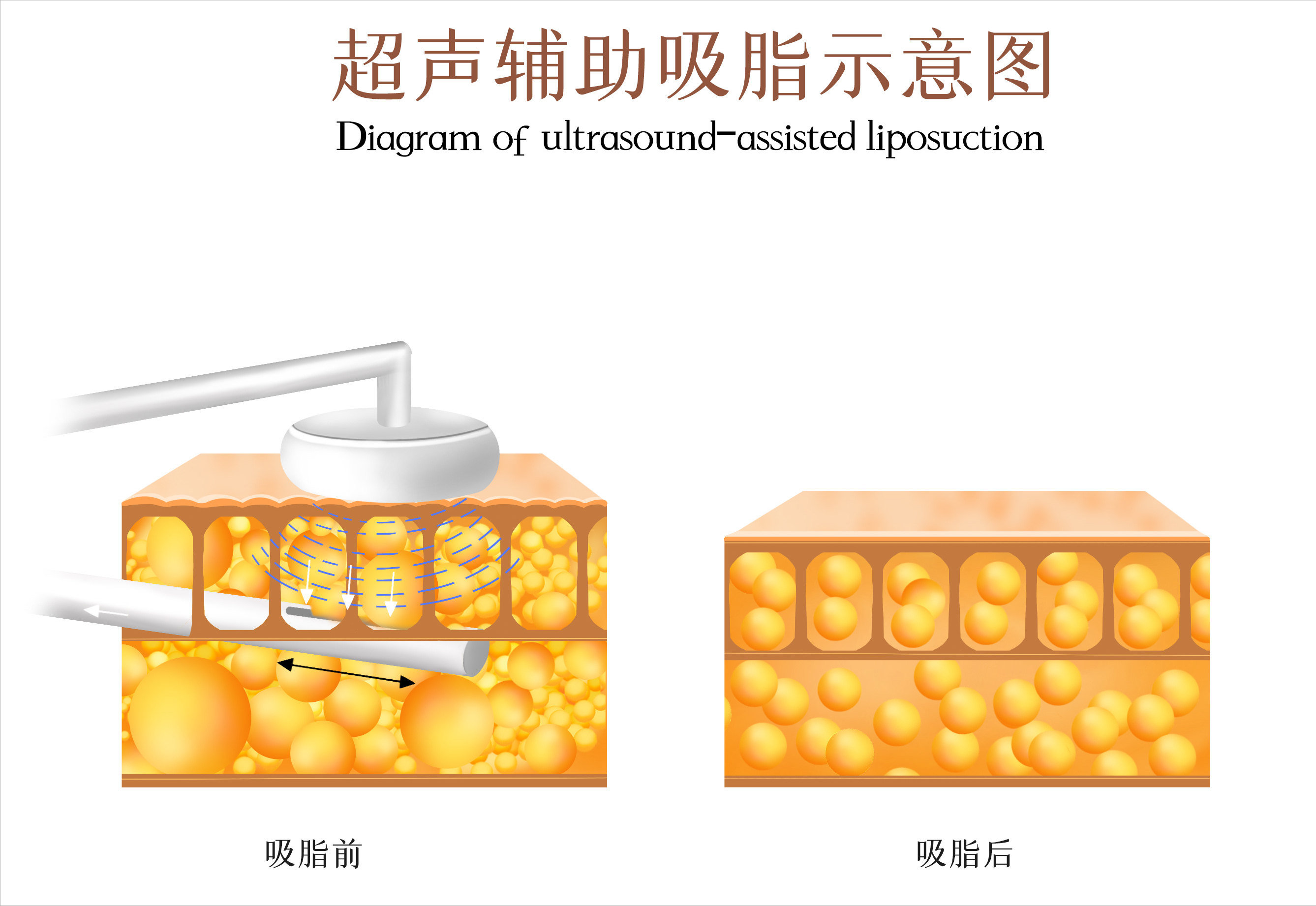 腰腹吸脂是难度最低的吸脂术吗？还会不孕？四个误区了解一下