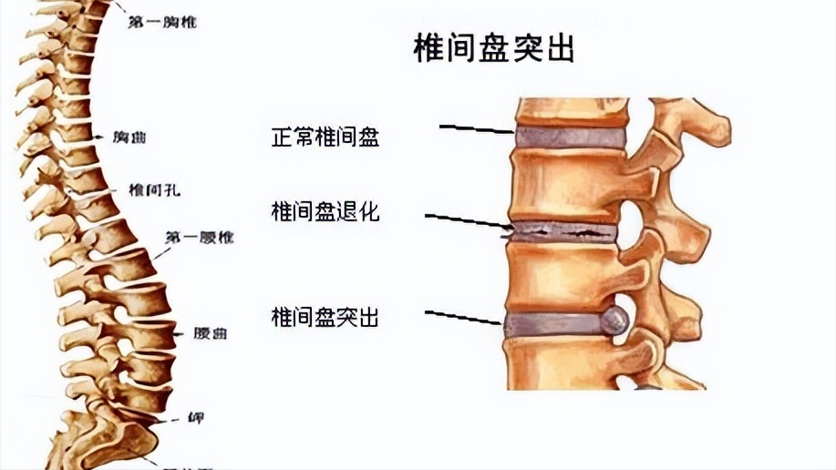 每天坚持吊单杠,腰间盘突出可以不药而愈?看医生咋说