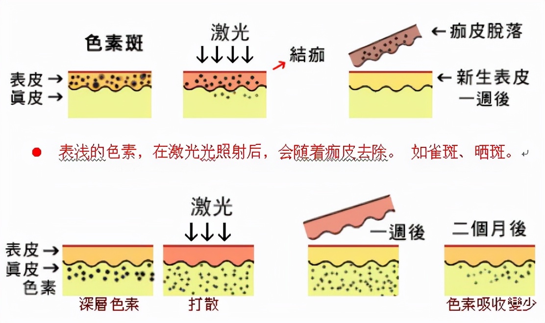 激光祛斑和皮秒祛斑其实是一个原理,皮秒只是一个速度的简称,皮秒激光