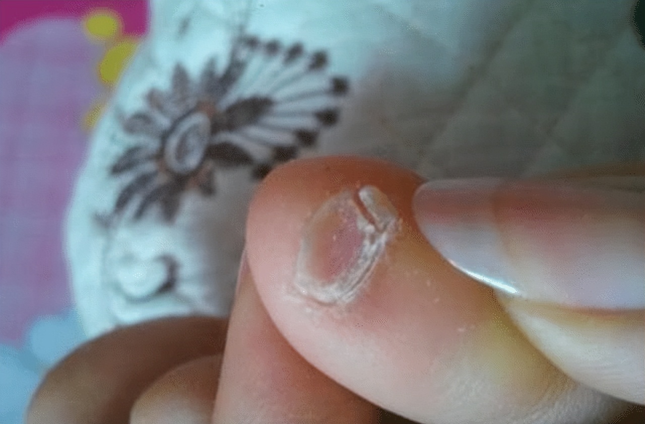 小脚趾指甲长成两瓣、三瓣的人，究竟是什么来历？有科学说法吗