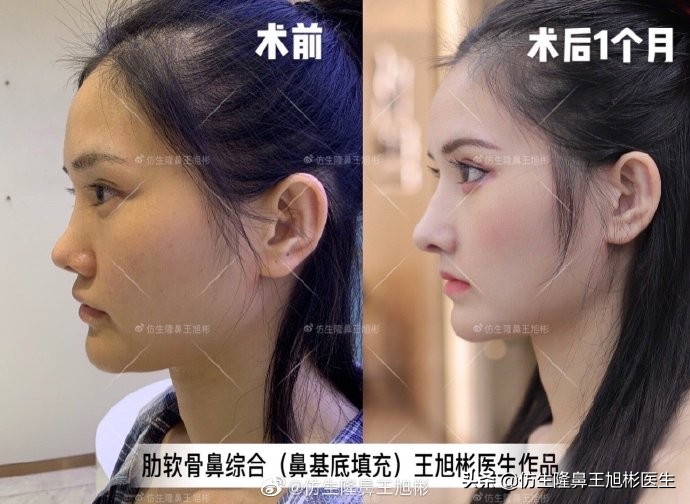 广州隆鼻科普：王旭彬鼻整形修复案例分享