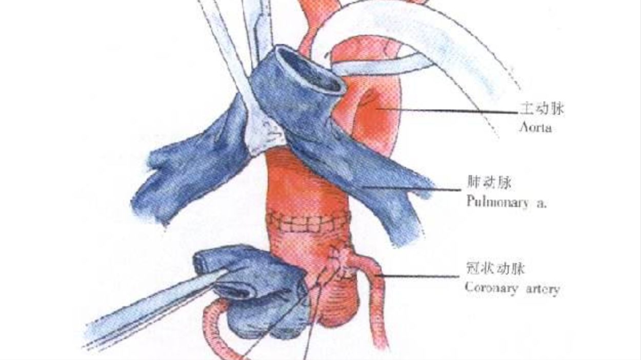 孩子确诊先心病——左冠状动脉异常起源于肺动脉，还有得治吗？