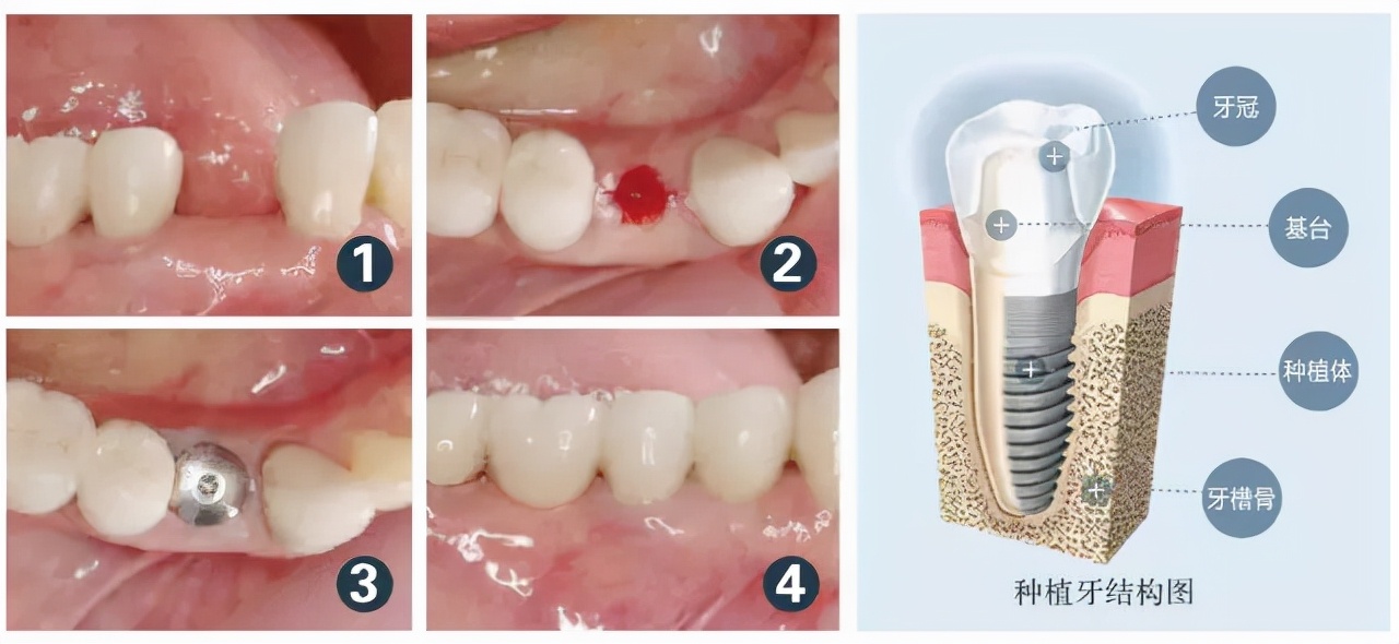 2种主流修复方式,口腔专家告诉你答案