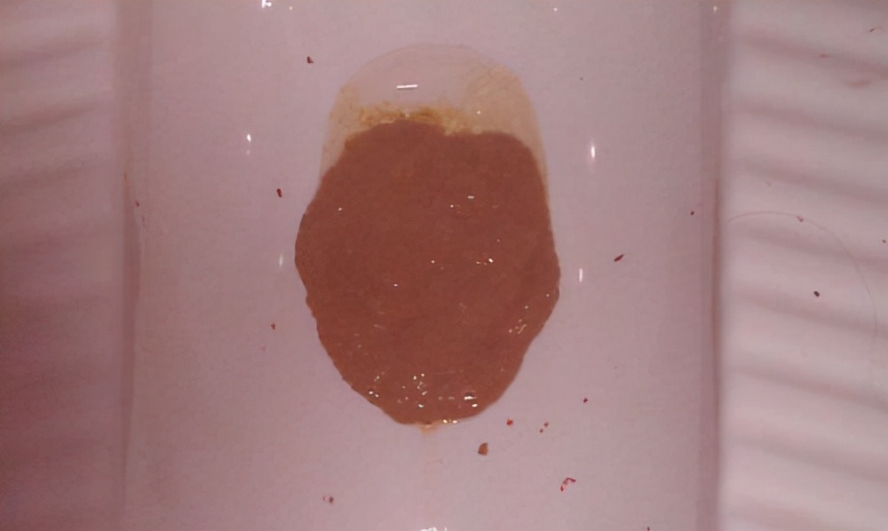 28岁女子晕厥,拉出柏油样黑便,家人拒绝手术,医生:命是自己的