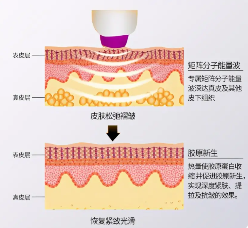 几分钟带你了解热玛吉