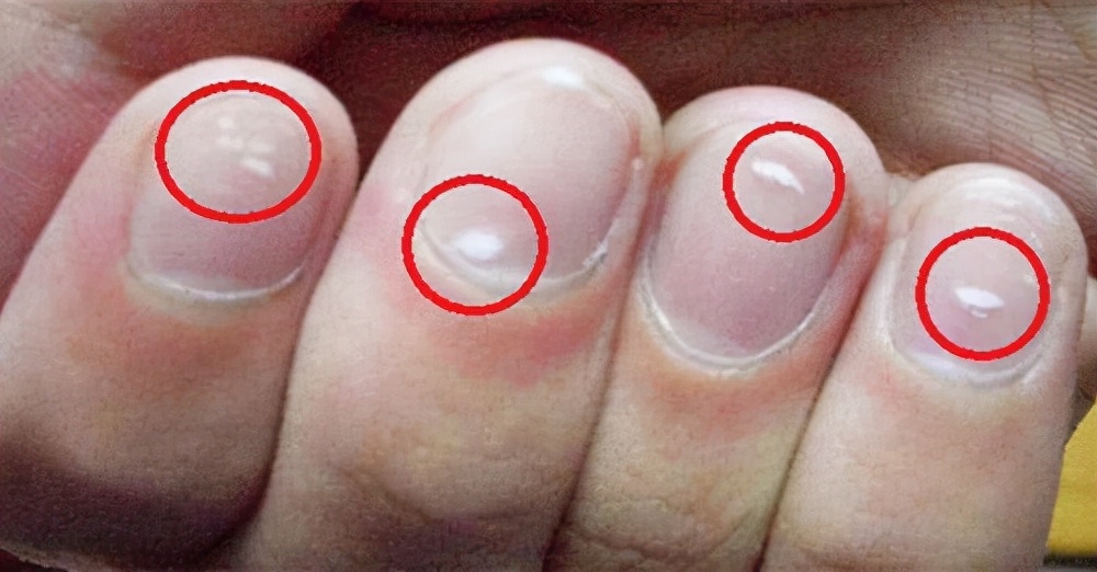 段时间内突然发现指甲上长出白斑,有的人认为是缺钙,有的人认为是缺锌