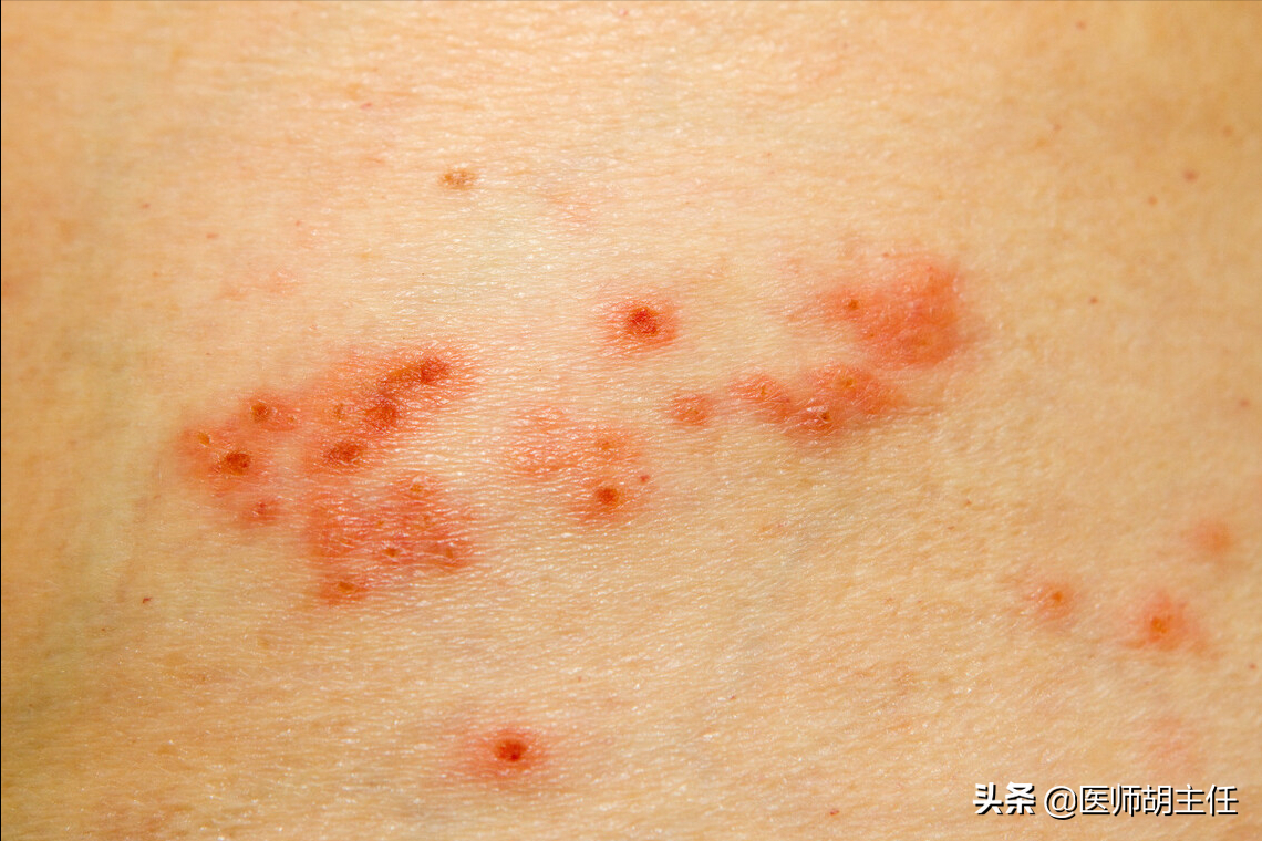 水痘-带状疱疹病毒在机体受到伤害的时候最容易入侵,所以对于这类病毒