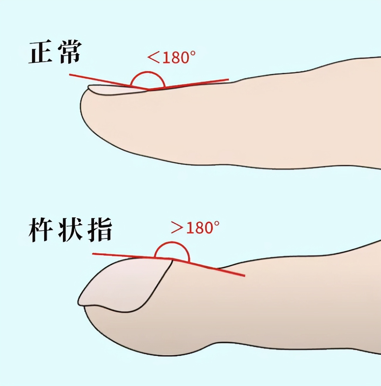 从手指也能看出肺癌？提醒：手指出现5个异常，赶紧排查病因