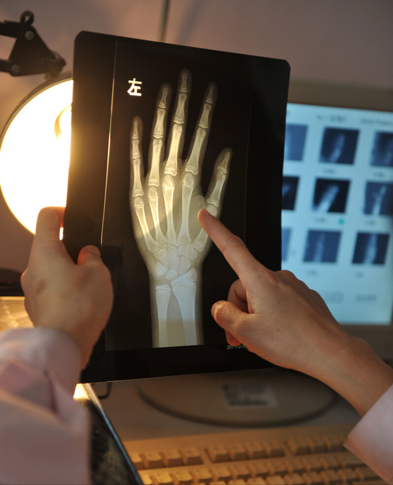 手指长歪了图片(孩子能长多高骨龄说了算) - 赤虎壹号