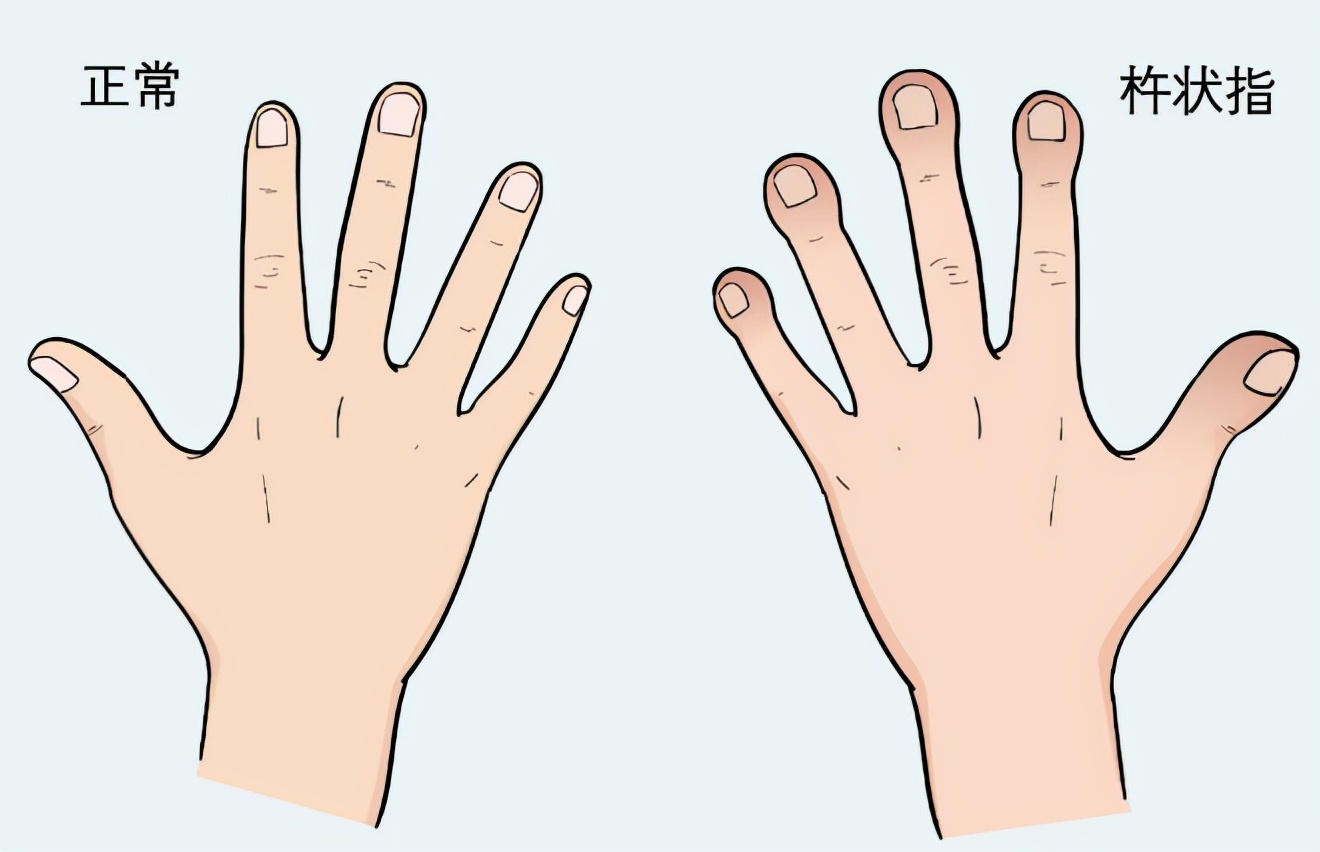 体内有病，手指先知？手指出现2种特征，要排除疾病或癌的可能性