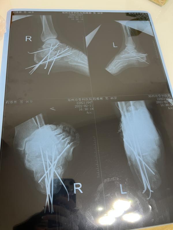 河南大叔跳下3米平臺(tái)救墜樓老人，雙腳粉碎性骨折釘入13根鋼釘