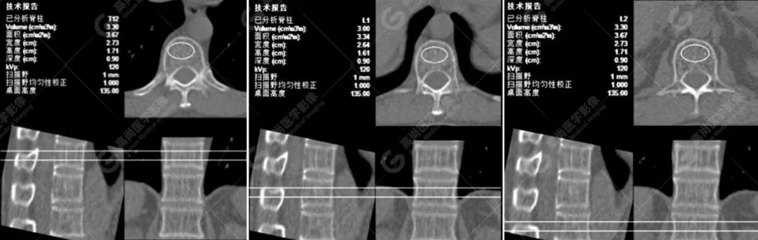 骨密度达到这个数，提醒你要补补钙了？专家为你解答