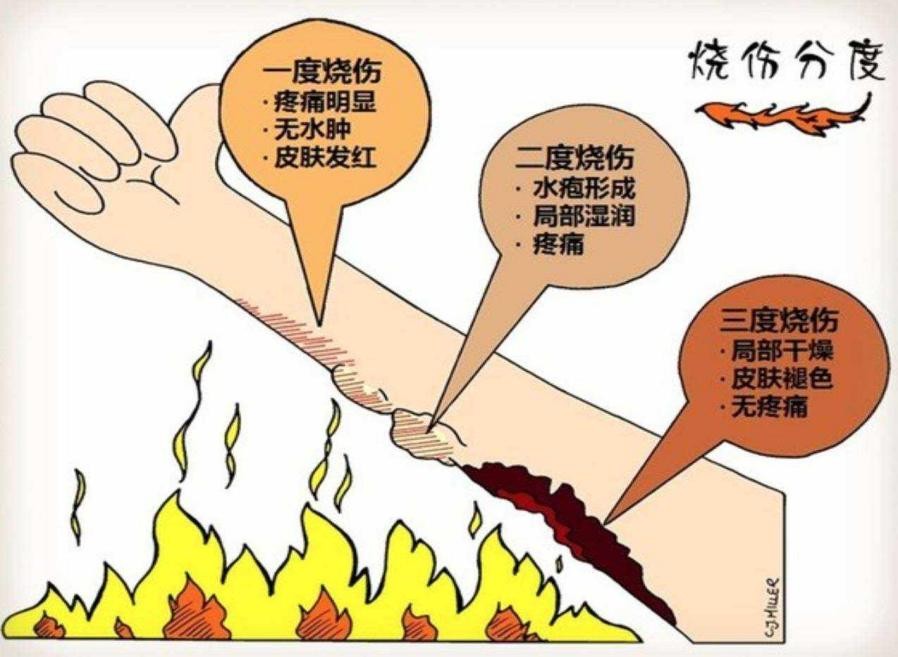 孩子被100度开水烫伤,家长仅冲水10秒却没脱衣服,害了孩子