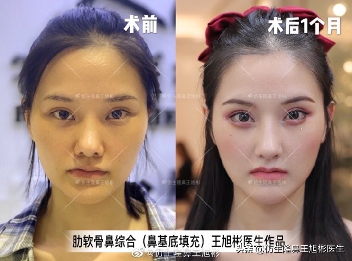 广州隆鼻科普：王旭彬鼻整形修复案例分享