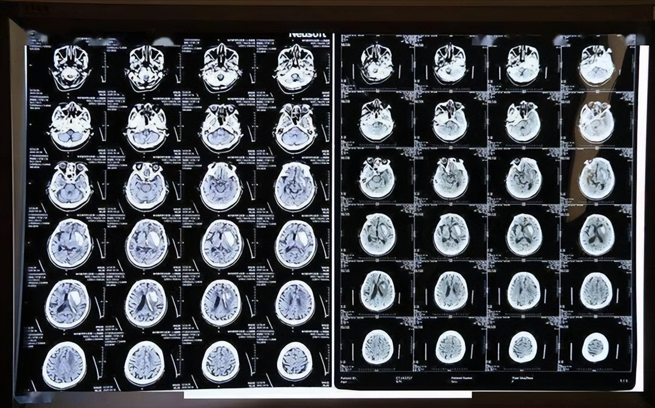 50岁后查脑CT，有这3种问题，别花冤枉钱，或不需要特殊治疗