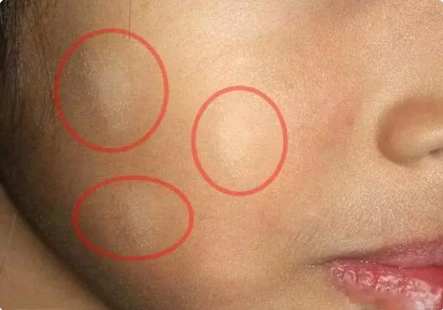 孩子脸上长白斑,先别着急"打虫",对症治疗很重要,以免娃自卑