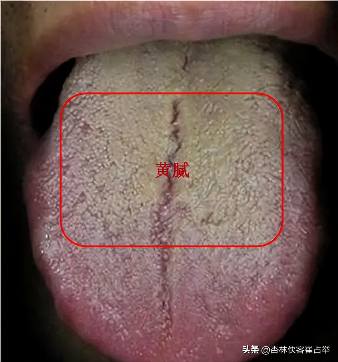 痰多怎麼辦(嗓子裡總有痰,痰多吐不完?醫生教你三個小方法解決它)