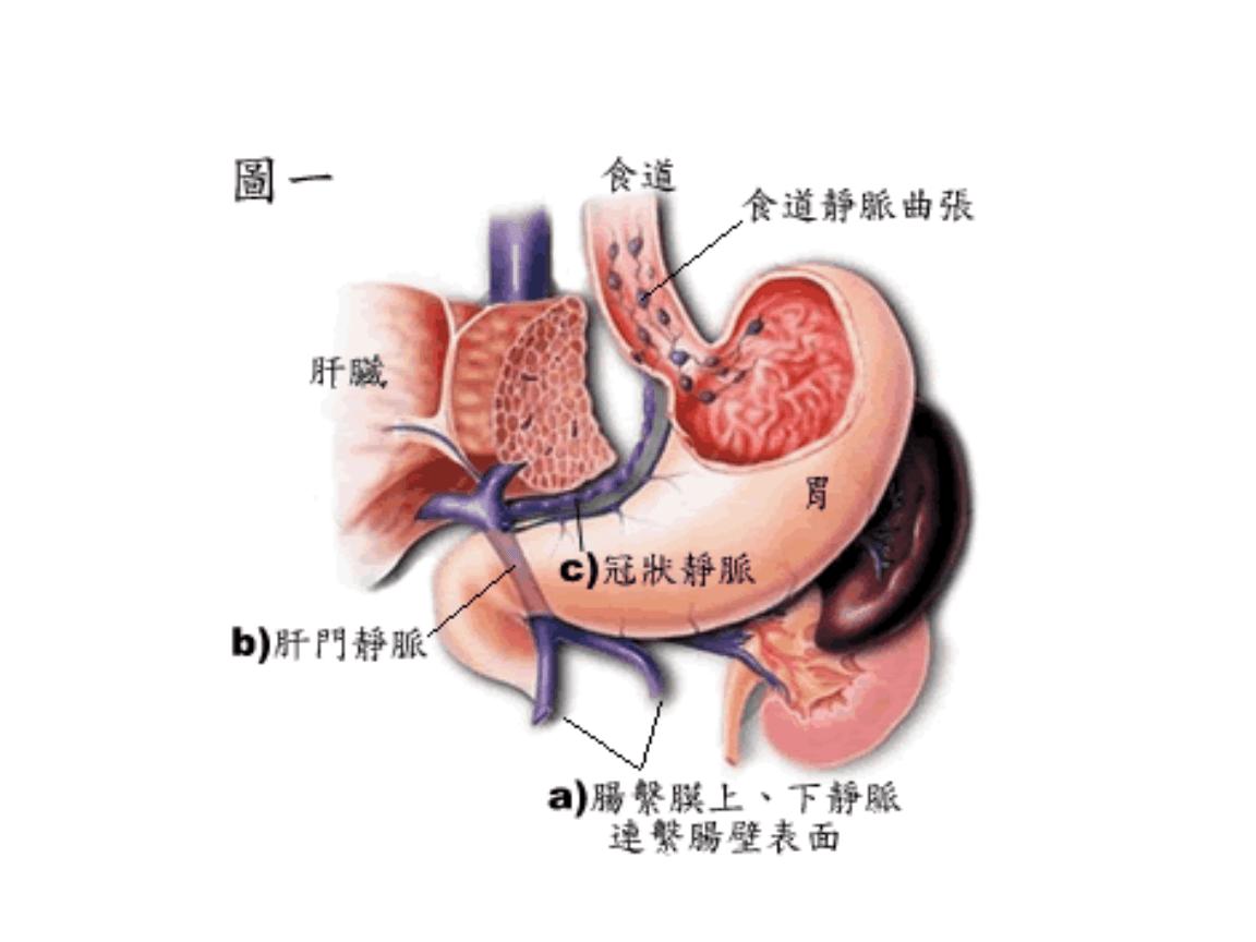生气会让人吐血？其实吐血多跟食管静脉曲张有关，原因居然在于肝